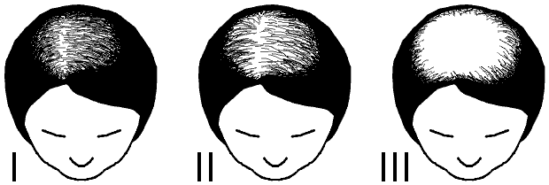 Naisten hiustenlähtö: Ludwigin asteikko
