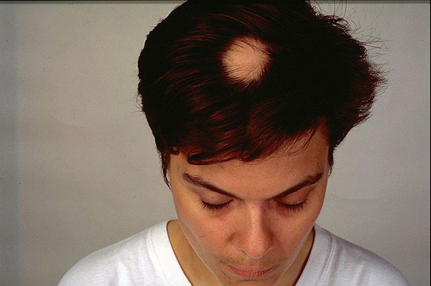 Alopecia areata eli pälvikalju naisella. Kuva Wikimedia Commons