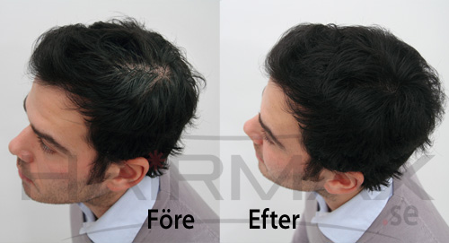 HairMax tuuhenteet ennen ja jälkeen kuva 1
