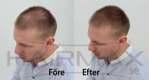 HairMax tuuhenteet ennen ja jälkeen kuva 2
