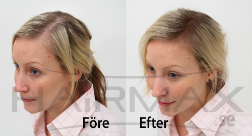 HairMax tuuhenteet ennen ja jälkeen kuva 3